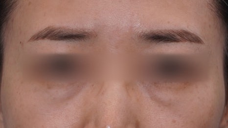 Under-Eye Fat Repositioning Recovery Period: Just Two Days! A Plastic Surgeon Reveals the Conditions for a Quick Return to Daily Life image 16