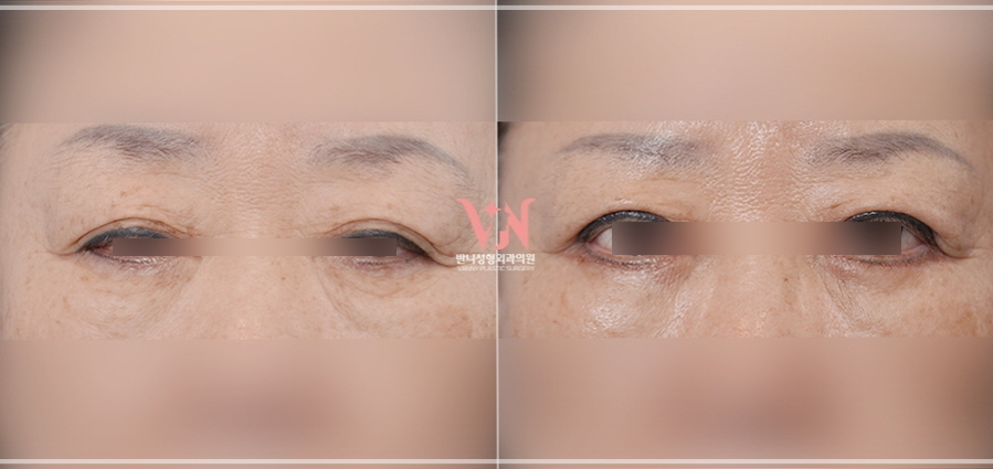 강남 하안검수술 잘하는 병원 가릴 수 있는 3가지 질문(부작용) 관련 이미지 10