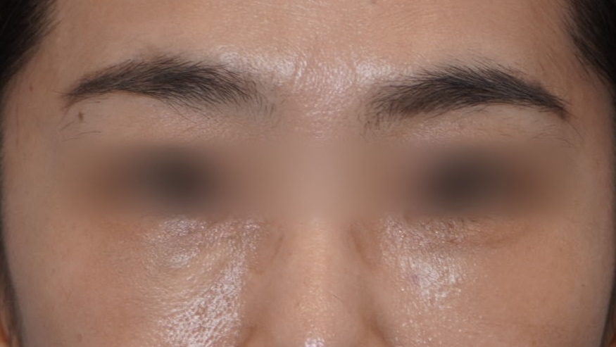 Eye Bag Repositioning Surgery Cost: A Plastic Surgeon Explains How to Find an Affordable, Good Clinic image 3