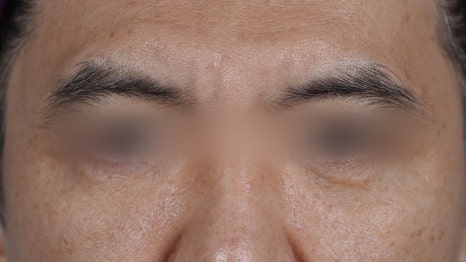 Under-Eye Fat Repositioning Recovery Period: Just Two Days! A Plastic Surgeon Reveals the Conditions for a Quick Return to Daily Life image 12