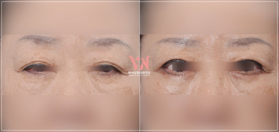 강남눈성형외과 잘하는 곳 구분하는 방법 3가지, 전문의가 알려드림 관련 이미지 7