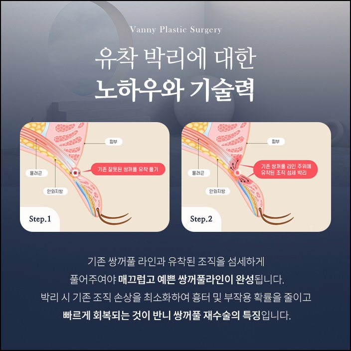 강남눈성형외과 두번의 실패를 하지 않기 위해 관련 이미지 4