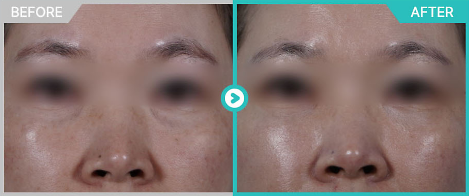 A Doctor with 20,000 Clinical Cases Shares How to Find the Best Under-Eye Filler Clinic in Gangnam image 3