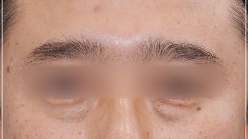 The One Critical Question to Avoid Revision Under-Eye Fat Repositioning (+Causes of Recurrence) image 9