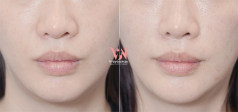 If your face is like this, "buccal fat removal" is not the first step — Gangnam "buccal fat lifting" is. image 29