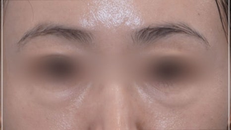 눈밑지방재배치 다크서클 해결 가능? 성형외과 전문의의 솔직 의견 관련 이미지 6