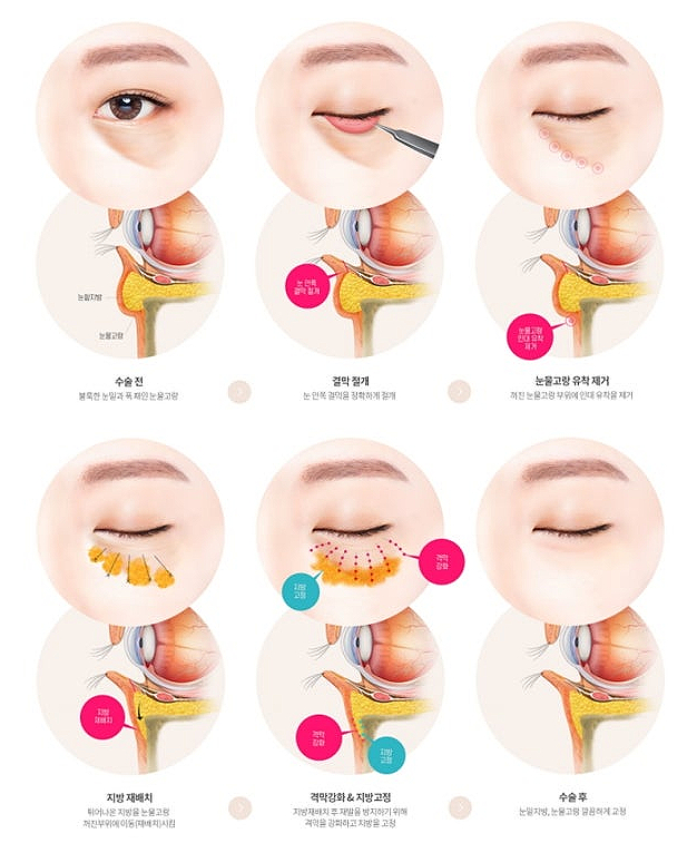 Conditions for Under-Eye Fat Repositioning in Gangnam That Lasts Long, Is Safe, and Allows a Quick Return to Daily Life image 8
