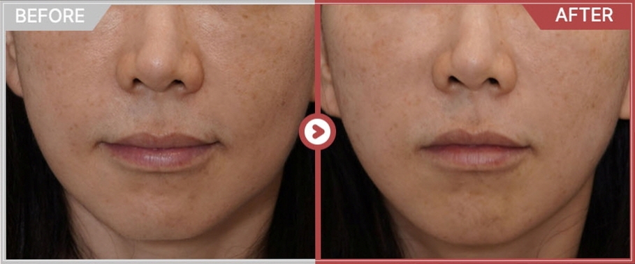 Thermage Effect Timing, Duration, and Treatment Interval: A Dermatology Director in Gangnam Shares an Honest View image 3