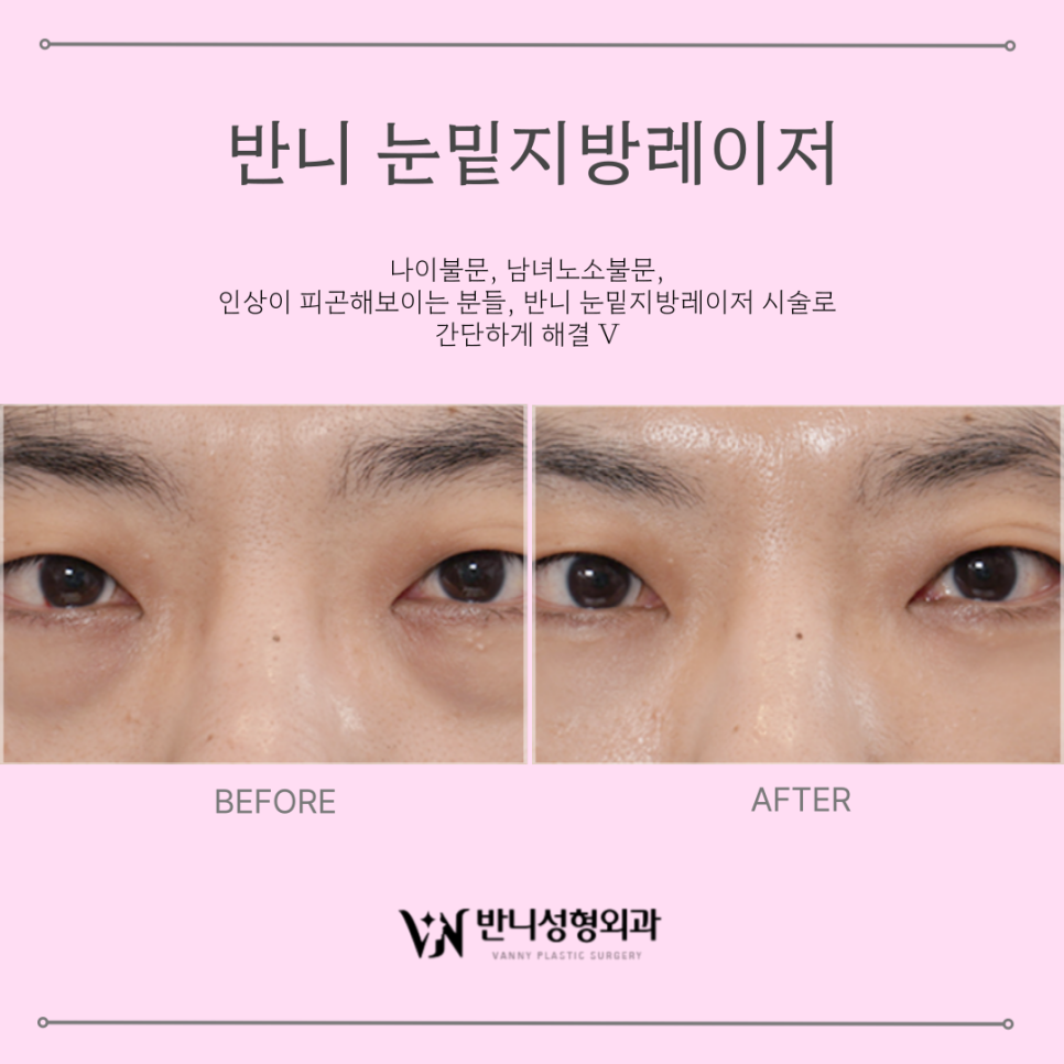 Under-Eye Fat Laser Treatment: Brightening the Eye Area Without the Burden image 4