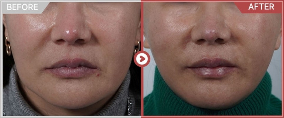 Do Not Go to a Clinic Where Thermage 300 Shots Cost Less Than 1 Million Won image 2