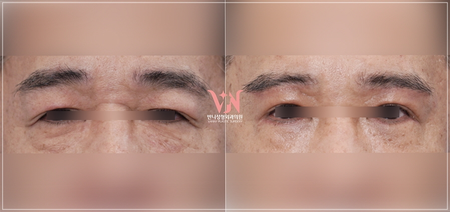 강남 눈밑지방재배치 재발없이가격까지 착한 병원 고르는 법 관련 이미지 20