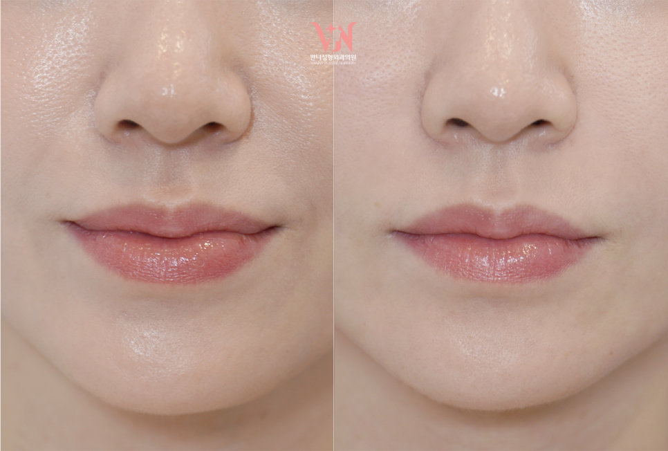If your face is like this, "buccal fat removal" is not the first step — Gangnam "buccal fat lifting" is. image 26