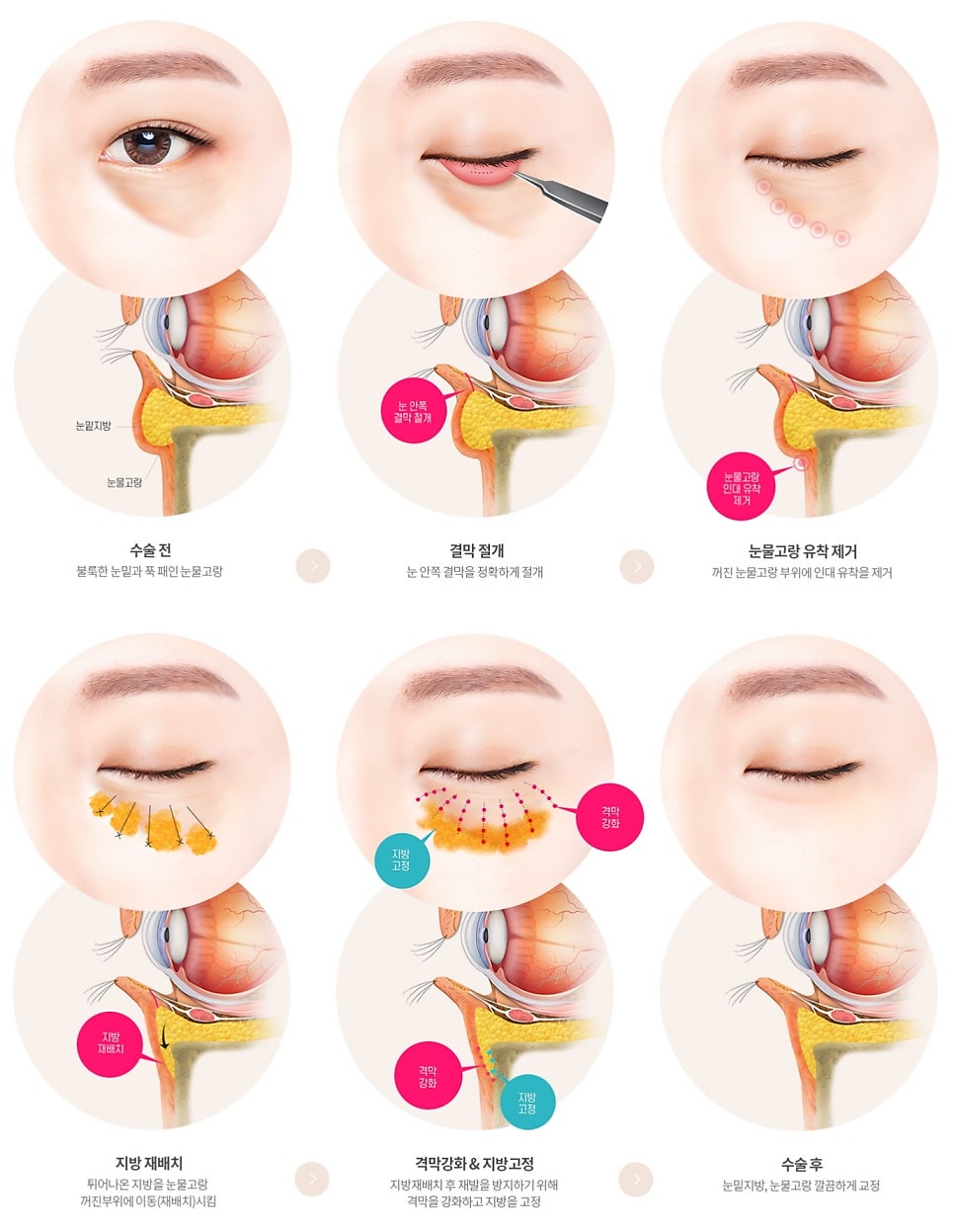 Under-Eye Fat Repositioning Recovery Period: Just Two Days! A Plastic Surgeon Reveals the Conditions for a Quick Return to Daily Life image 18