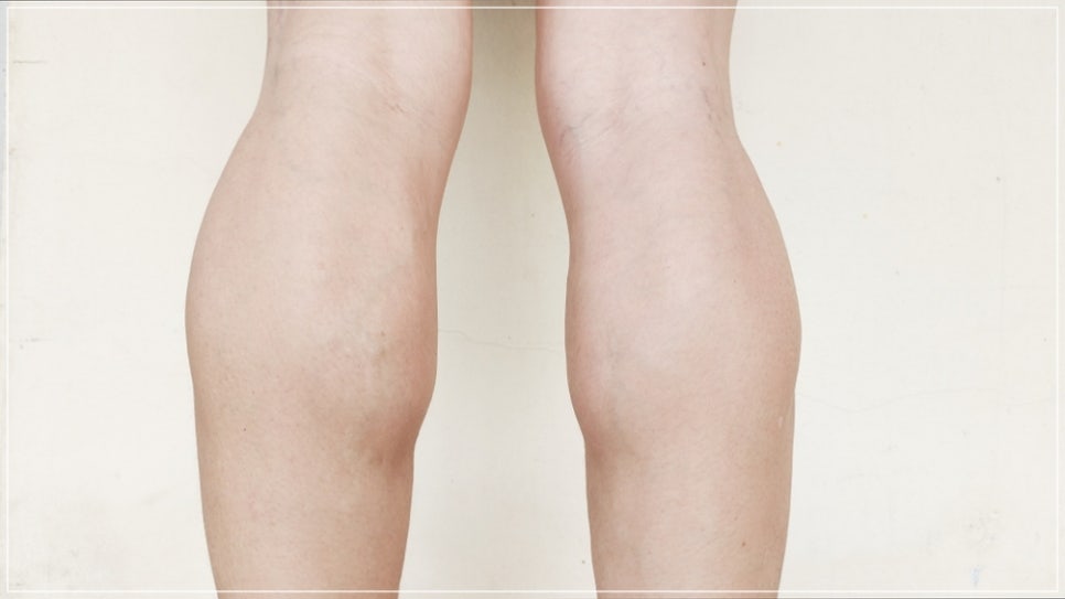 What Is a Dermatology Clinic That Does Great Calf and Trapezius Botox, Hyperhidrosis Botox, and Fat-Dissolving Injections for Body Care in Gangnam? (+Event) image 3