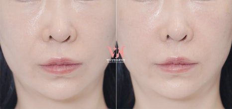 If your face is like this, "buccal fat removal" is not the first step — Gangnam "buccal fat lifting" is. image 28