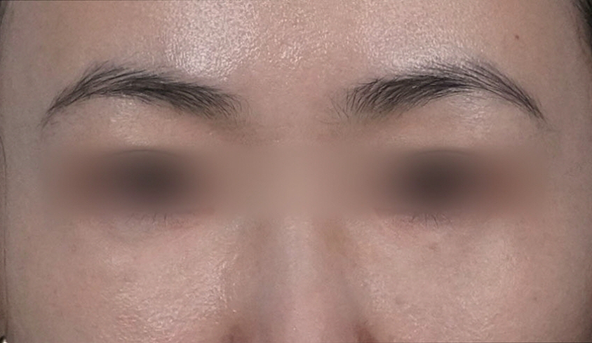 눈밑지방재배치 다크서클 해결 가능? 성형외과 전문의의 솔직 의견 관련 이미지 5