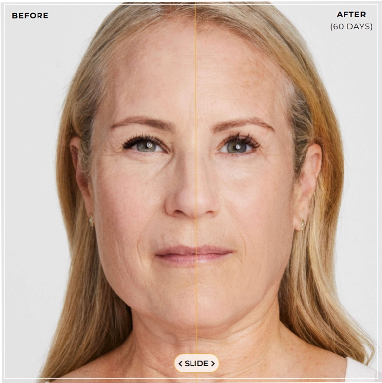 Ultherapy Effectiveness: Fact Check for Thin Faces O, Filling Sunken Areas X (+ Gangnam Event Dermatology Clinic) image 7