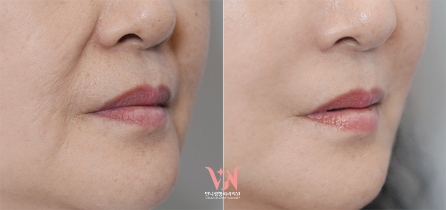 If your face is like this, "buccal fat removal" is not the first step — Gangnam "buccal fat lifting" is. image 20