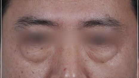 눈밑지방재배치 다크서클 해결 가능? 성형외과 전문의의 솔직 의견 관련 이미지 15