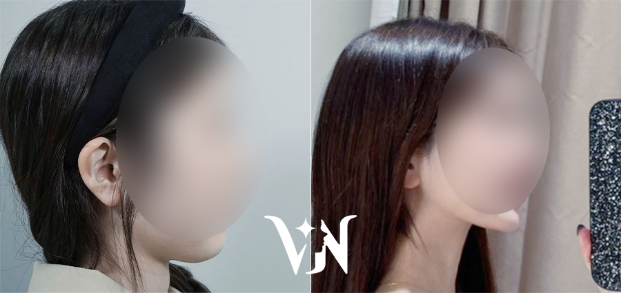 "울쎄라피 프라임이 덜 아프대요" 이걸 믿으세요? 관련 이미지 17