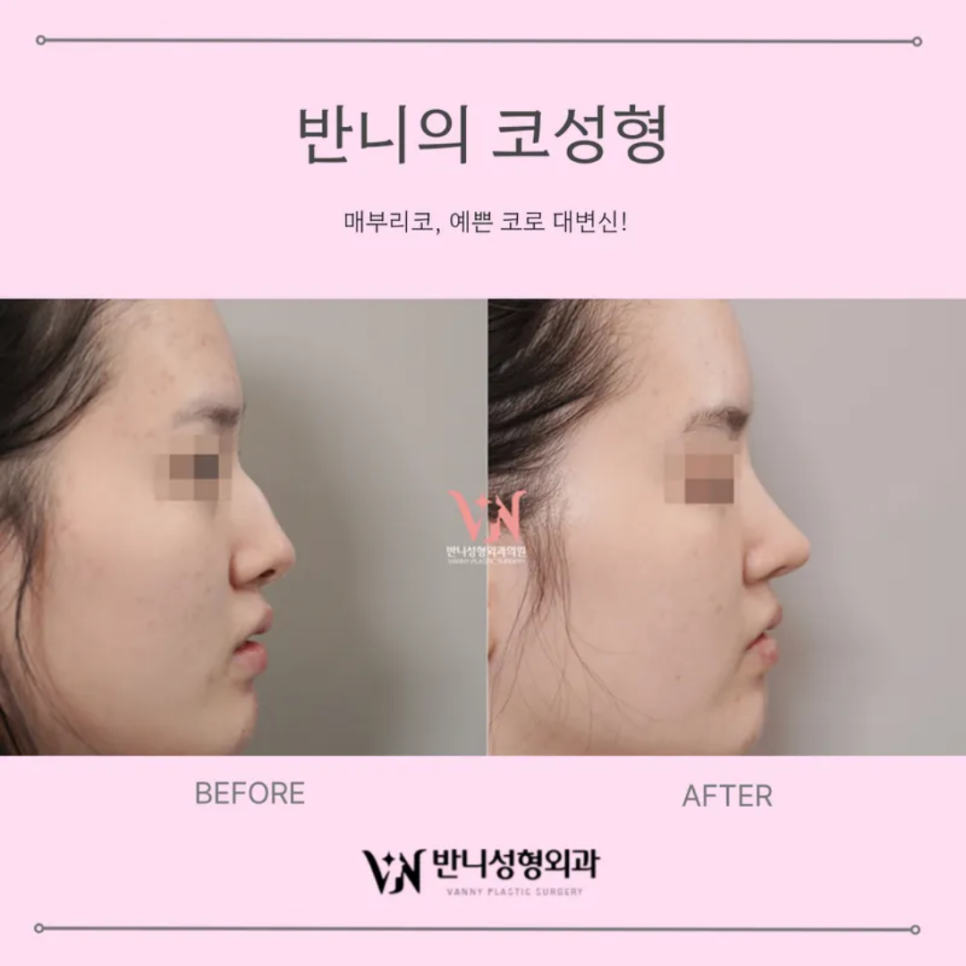 Gangnam Rhinoplasty: The Process of Finding Natural Proportions and Harmony image 4