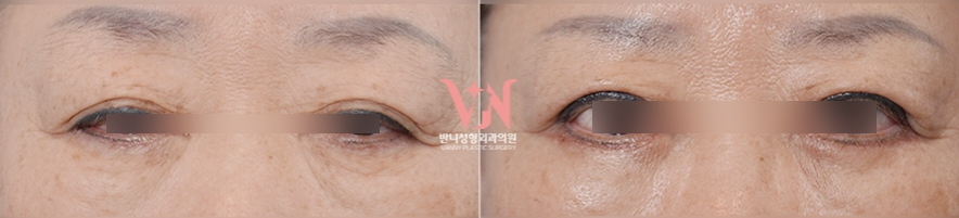 Conditions for Under-Eye Fat Repositioning in Gangnam That Lasts Long, Is Safe, and Allows a Quick Return to Daily Life image 15