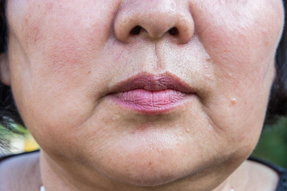 If your face is like this, "buccal fat removal" is not the first step — Gangnam "buccal fat lifting" is. image 9