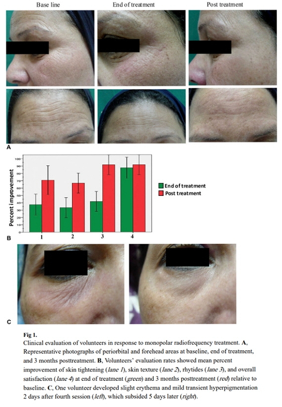 Thermage Effect Timing, Duration, and Treatment Interval: A Dermatology Director in Gangnam Shares an Honest View image 7