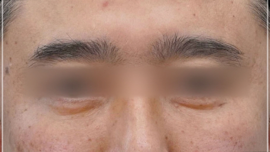 The One Critical Question to Avoid Revision Under-Eye Fat Repositioning (+Causes of Recurrence) image 10