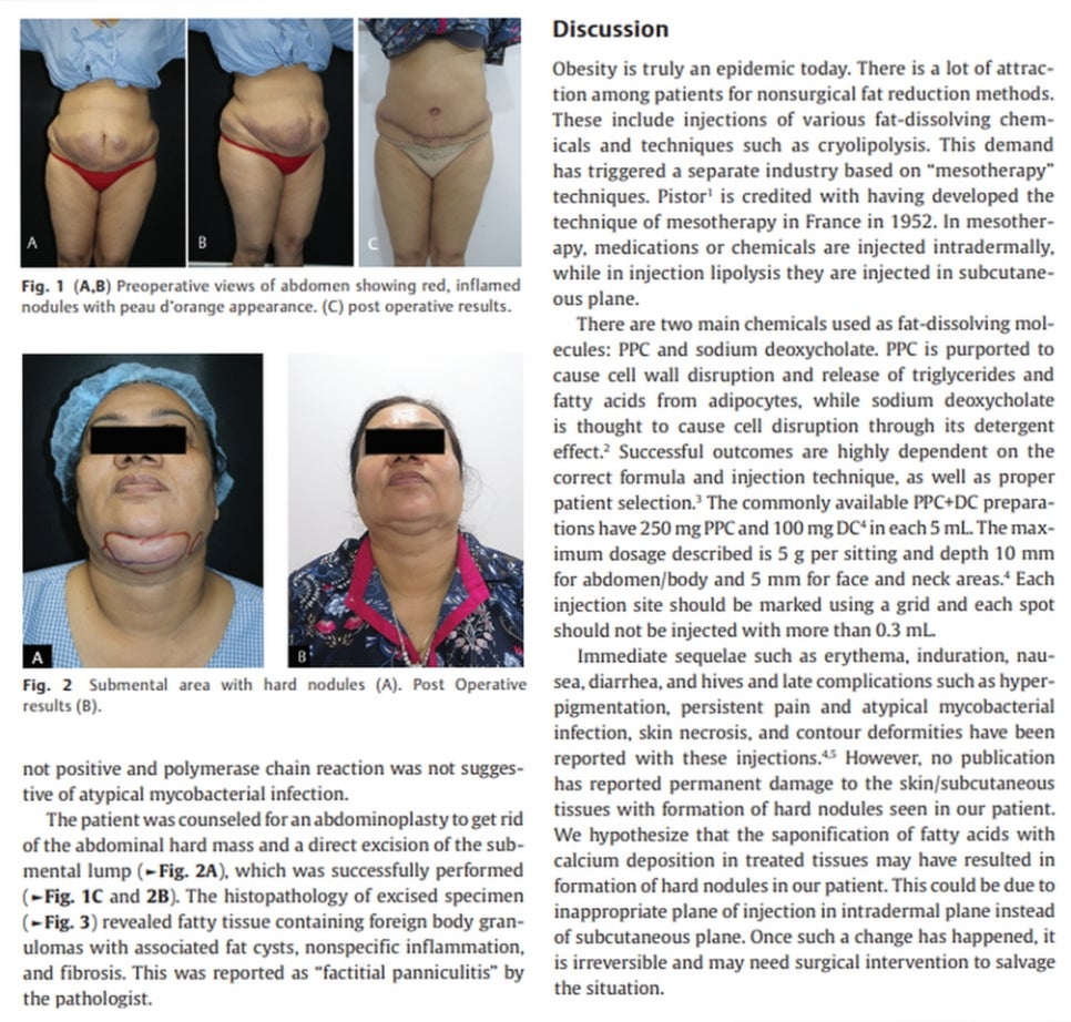 What Is a Dermatology Clinic That Does Great Calf and Trapezius Botox, Hyperhidrosis Botox, and Fat-Dissolving Injections for Body Care in Gangnam? (+Event) image 16