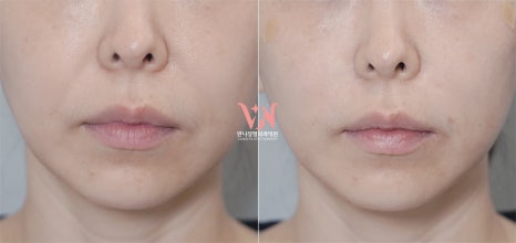 If your face is like this, "buccal fat removal" is not the first step — Gangnam "buccal fat lifting" is. image 30