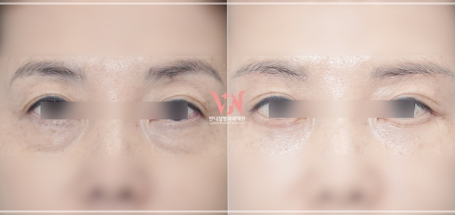 강남 하안검수술 잘하는 병원 가릴 수 있는 3가지 질문(부작용) 관련 이미지 5