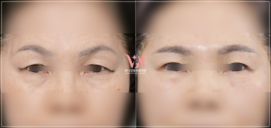 Midlife Eyelid Sagging Surgery: Which Cases Are Suitable for Upper Blepharoplasty or Brow Lift, Scars, Recovery Time — This Article Answers It All image 3
