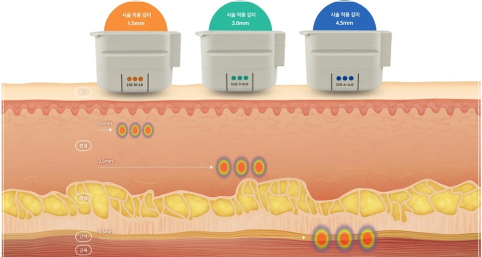 A Place Near Gangnam Station That Does Ulthera Well: Just Remember These 3 Things image 10