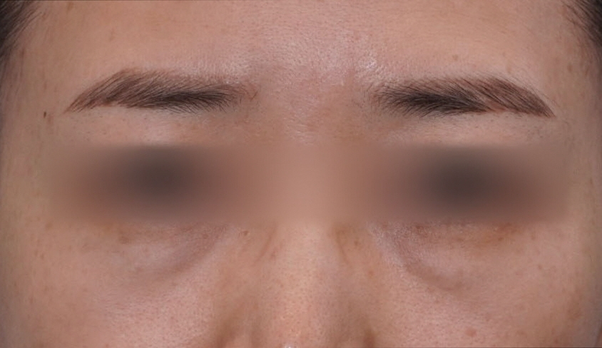 눈밑지방재배치 다크서클 해결 가능? 성형외과 전문의의 솔직 의견 관련 이미지 17