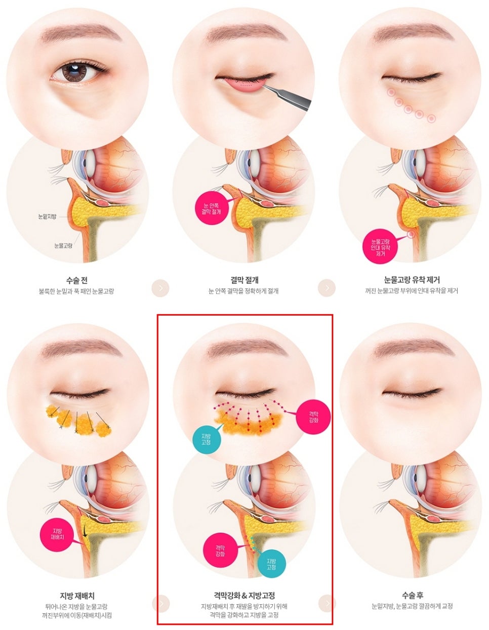 강남 눈밑지방재배치 재발없이가격까지 착한 병원 고르는 법 관련 이미지 11