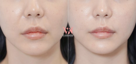 If your face is like this, "buccal fat removal" is not the first step — Gangnam "buccal fat lifting" is. image 38