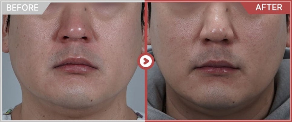 Do Not Go to a Clinic Where Thermage 300 Shots Cost Less Than 1 Million Won image 5