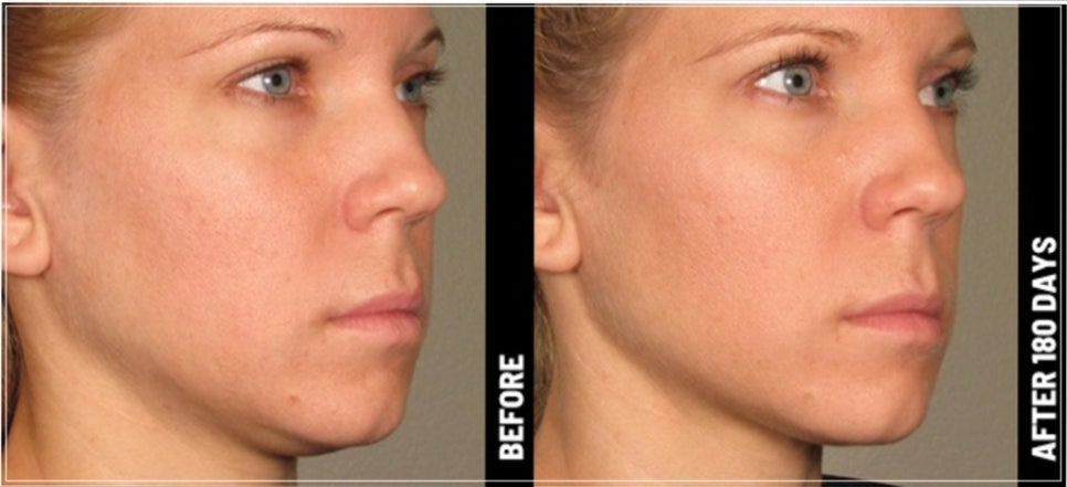 When Does Ulthera Start Working? Changes After 3 Months and 6 Months (+How to Extend the Maintenance Period) image 4