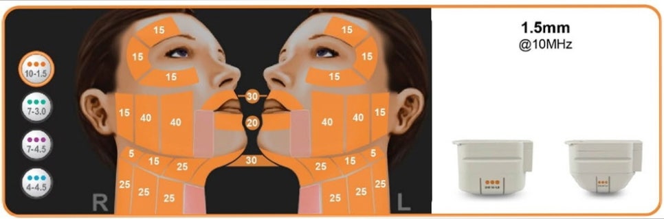 Eye Thermage and Eye Ulthera: Treatment Areas and Effects, a Dermatology Director's Honest Opinion image 17