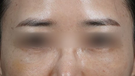 Under-Eye Fat Repositioning Recovery Period: Just Two Days! A Plastic Surgeon Reveals the Conditions for a Quick Return to Daily Life image 17