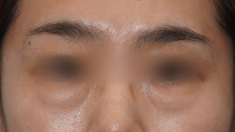 Eye Bag Repositioning Surgery Cost: A Plastic Surgeon Explains How to Find an Affordable, Good Clinic image 4