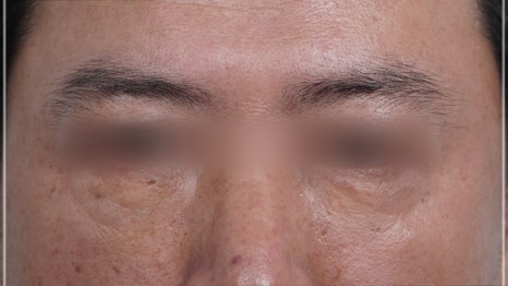 눈밑지방재배치 다크서클 해결 가능? 성형외과 전문의의 솔직 의견 관련 이미지 16
