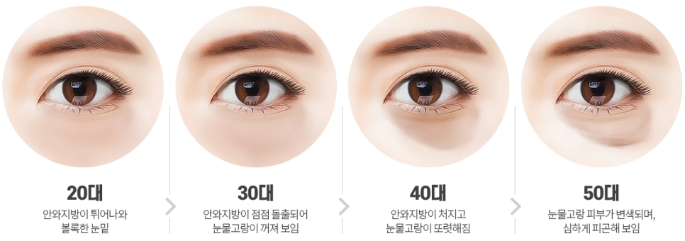 눈밑지방재배치 다크서클 해결 가능? 성형외과 전문의의 솔직 의견 관련 이미지 3