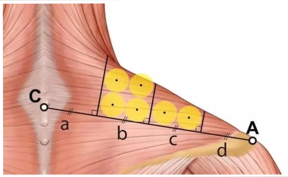What Is a Dermatology Clinic That Does Great Calf and Trapezius Botox, Hyperhidrosis Botox, and Fat-Dissolving Injections for Body Care in Gangnam? (+Event) image 7