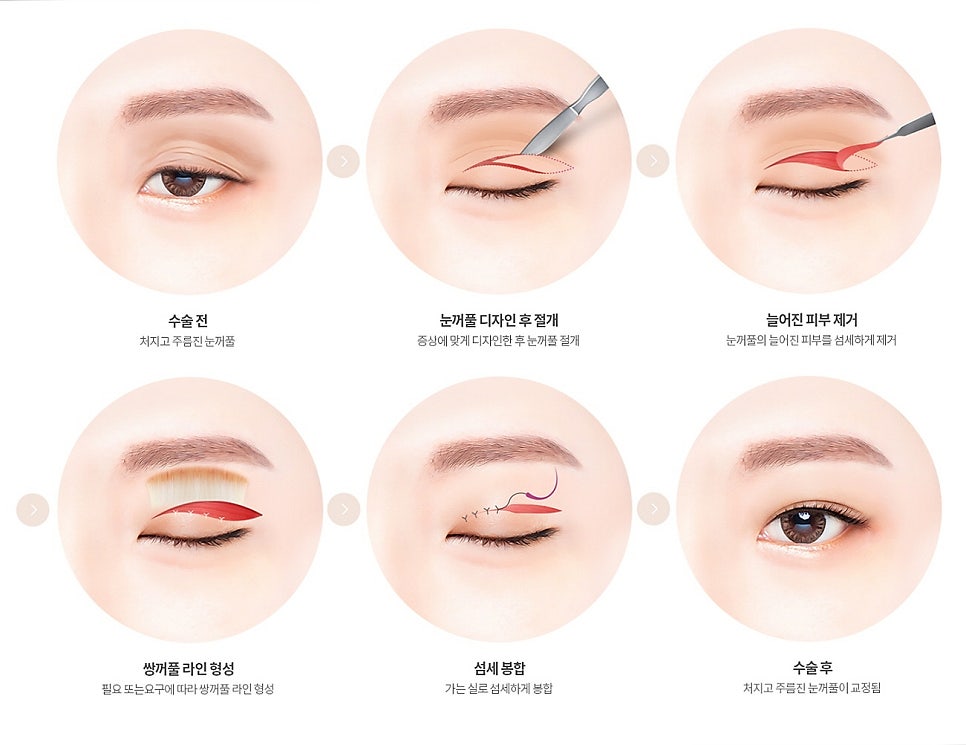 A Case Where Upper Blepharoplasty in Gangnam Won’t Help, a Plastic Surgeon’s Honest Opinion image 9