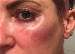 Gangnam Re2O Treatment: Controversy Over Use of Human Tissue and Side Effects? Misconceptions and Facts About Re2O. image 22