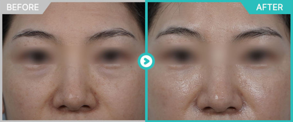 A Doctor with 20,000 Clinical Cases Shares How to Find the Best Under-Eye Filler Clinic in Gangnam image 5