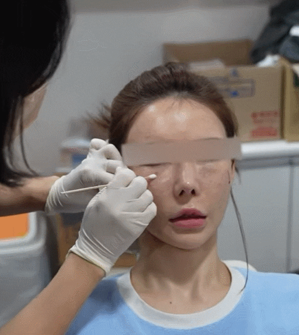 눈밑지방재배치 시술 효과, 통증, 붓기, 후 관리까지 이 글로 종결 관련 이미지 8