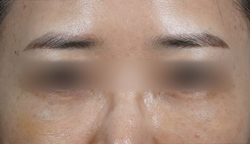 눈밑지방재배치 다크서클 해결 가능? 성형외과 전문의의 솔직 의견 관련 이미지 18